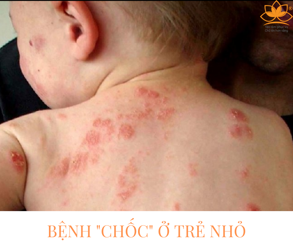 BỆNH CHỐC Ở TRẺ NHỎ